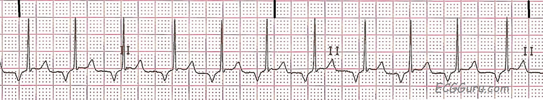 ecg-basics-retrograde-p-waves-ecg-guru-instructor-resources